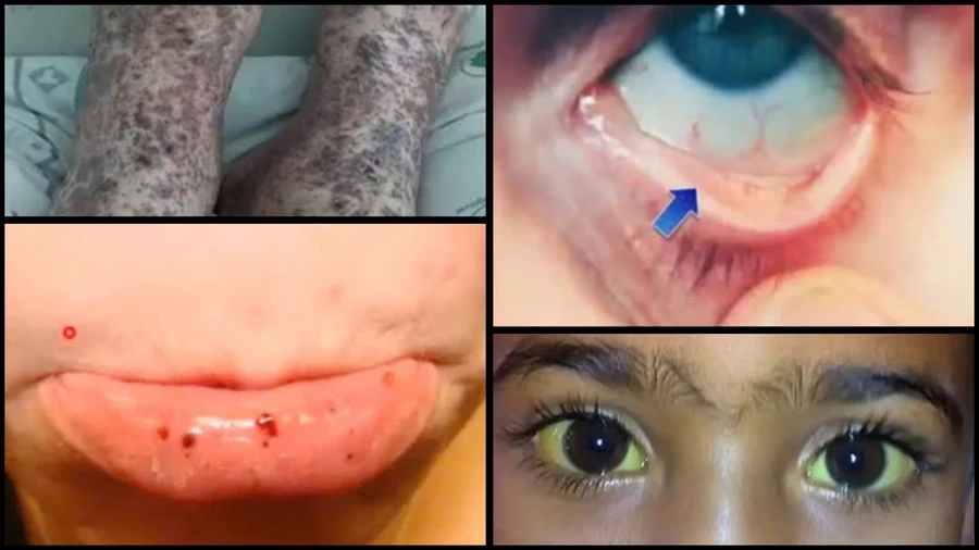 Các triệu chứng thường gặp của hội chứng Evans.
